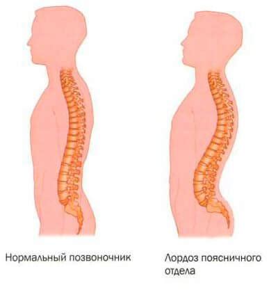 Лечение лордоза у детей и взрослых в Одессе