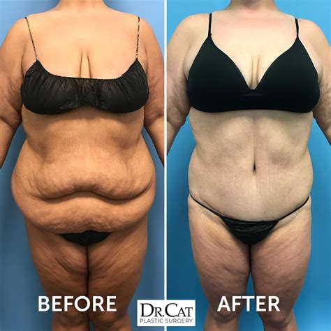 Laser Liposuction Vs Tummy Tuck at Samantha Tomlinson blog