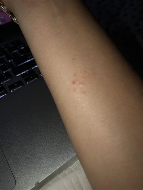 Weird rash/ bug bite. Please diagnose its really itchy! Ive had for a ...