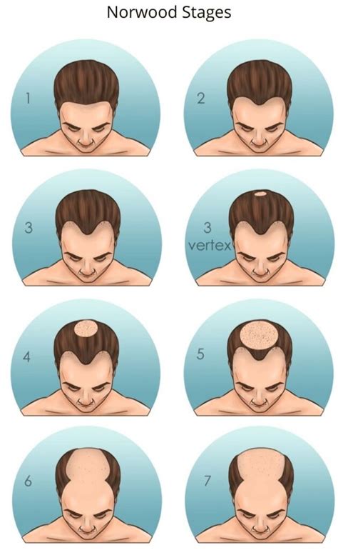 hair transplant  receding hairline heva clinic