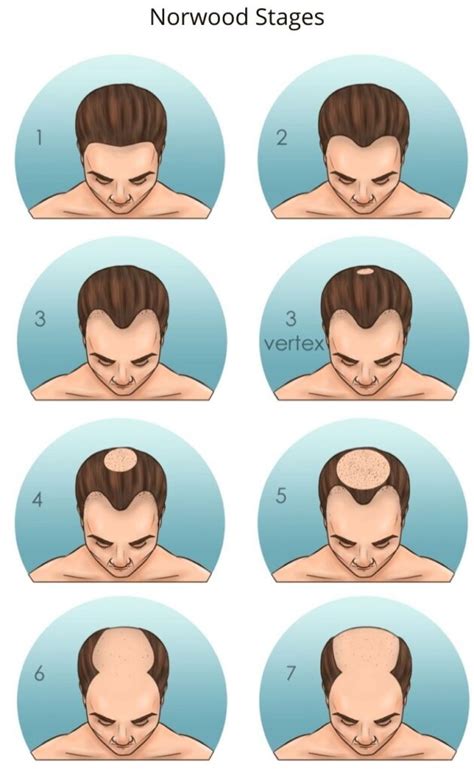 How To Tell If You Have A Receding Hairline