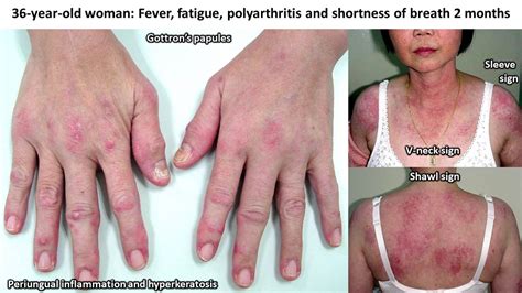 Spot Diagnosis in Rheumatology