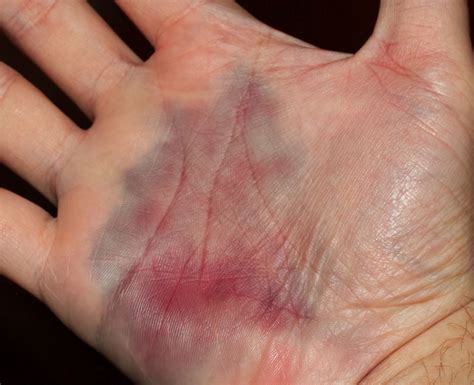 bloody cuts  wrist