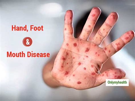 Hand Foot Mouth Rash Causes - Infoupdate.org