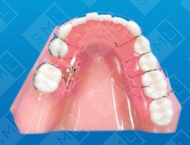 orthodontic space maintainer
