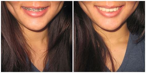 Braces Before And After India at Dane Figueroa blog