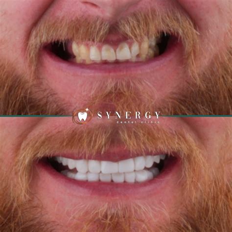 Composite bonding 911 • Synergy Dental Clinic 