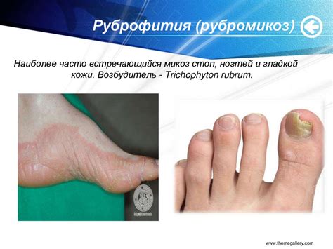 Грибковые заболевания кожи - online presentation