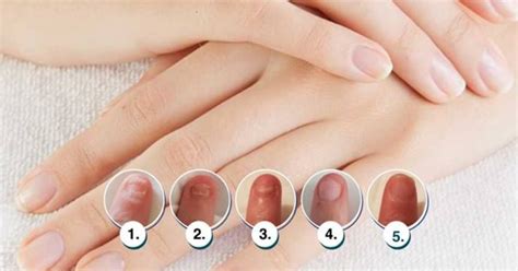 Unveiling Nail Fungal Infections: Causes, Candida Connection, and Foods ...