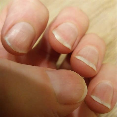 Nail Biting Relapse: How To Break The Nail Biting Habit – End Nail Biting