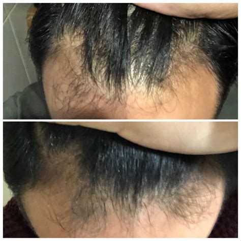 6 months on propecia and minoxidil 5%, the picture on the upper side is