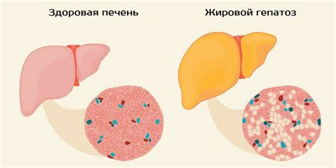 Жировой гепатоз – лечение, симптомы, причины, профилактика, прогноз ...