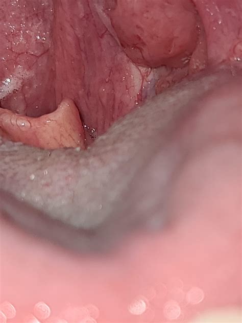 fleshy skin tag on tonsil