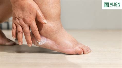 Why Diabetics Should Never Ignore Foot Swelling - Align Foot & Ankle