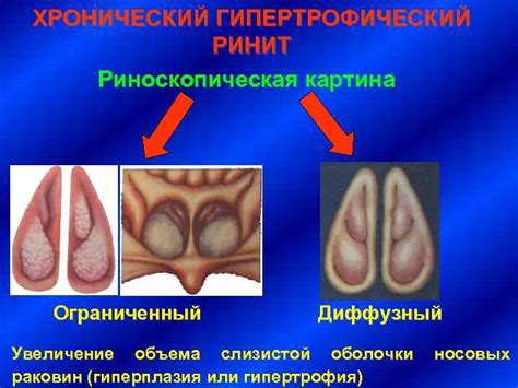 ФИЗИОЛОГИЯ НОСА ТРАВМЫ НОСА НОСОВЫЕ КРОВОТЕЧЕНИЯ ОСТРЫЙ И