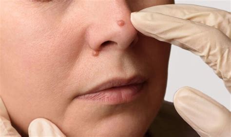Hypothyroidism: Symptoms may include dull facial expressions | Express ...
