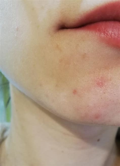 [skin concern] Can I get an allergic reaction like this to The Ordinary