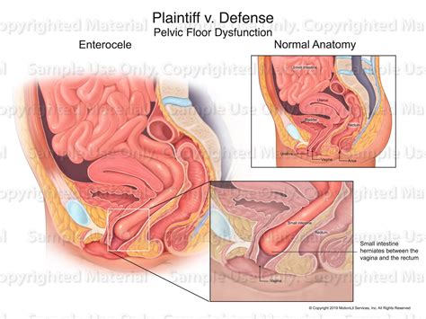 Pelvic Floor Dysfunction - MotionLit