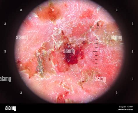 dermatoscope image  pemphigus foliaceus lesions   skin