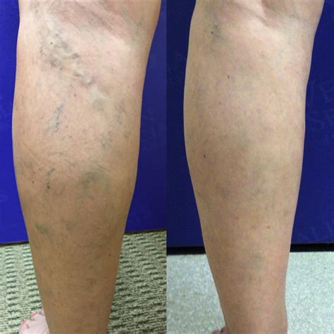 Sclerotherapy Is a Less-Invasive Way To Get Rid of Spider Veins - Vein ...