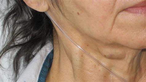 Jugular Vein Distention (JVD): Causes And Treatments, 57% OFF