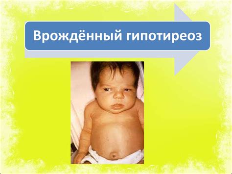 Скрининг при врождённом гипотиреозе - презентация онлайн