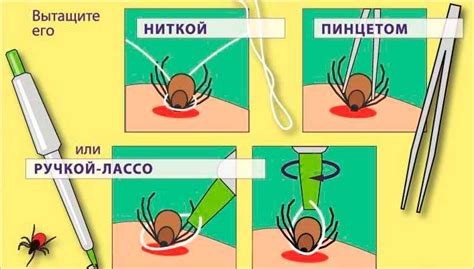 Первая помощь при укусе клеща
