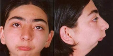 Micrognathia - Causes and Treatment of Micrognathia