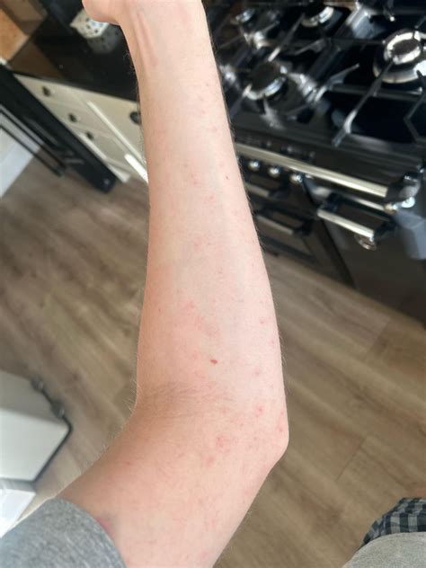 Does this look like scabies? : r/scabies