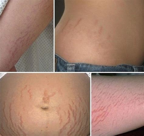 ran da va cach chua ran da hieu qua cho phai dep