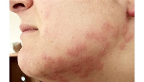 Flea Bites On Face