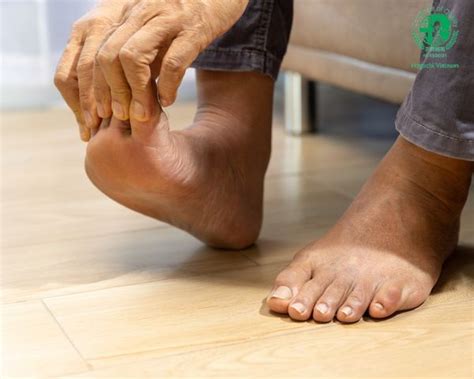 Bệnh Gout Là Gì? Nguyên Nhân, Dấu Hiệu, Biến Chứng Và Cách Phòng Ngừa ...