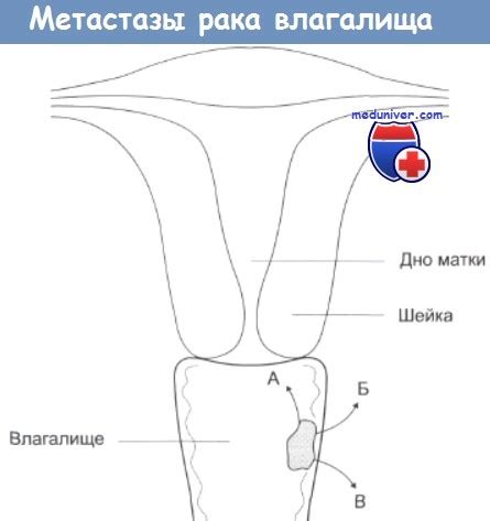Карцинома (рак) влагалища - клиника, диагностика, стадии