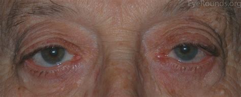 A Primer on Ptosis