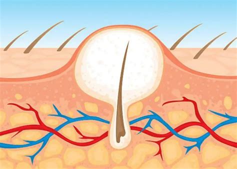 Ingrown Hair on Scalp (Head) with Cyst, Bump: Causes & Removal - Treat