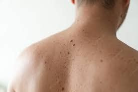 Unveiling the Mystery: Mikhail Gorbachev's Birthmark - Itechment