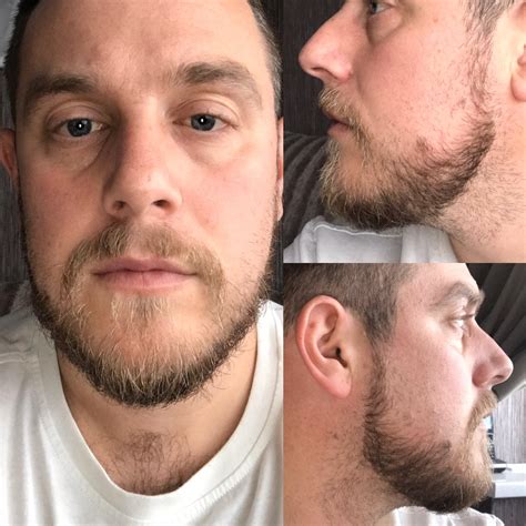 Help, beard growing in different directions and is thin, longer it gets