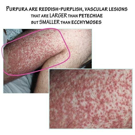 Clinical Pathology Glossary: Purpura | ditki medical & biological sciences