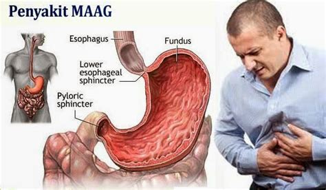 Gejala Penyakit Maag Kronis dan Cara Pengobatan Sistem Herbal