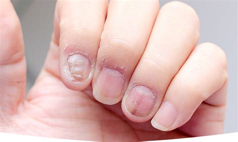 The Most Common Causes of Nail Fungus - Celebblink