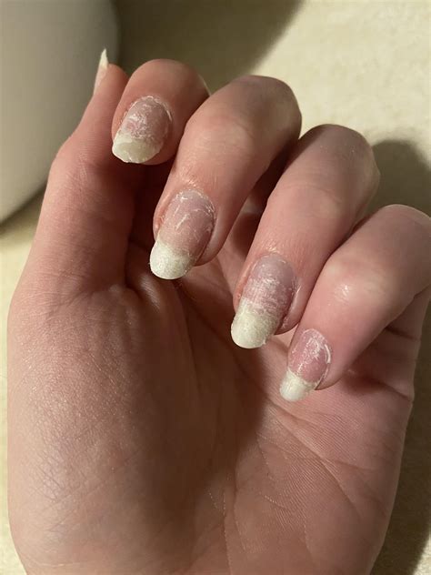 Nails look horrendous after removing gel!! What can I do?? I don't have