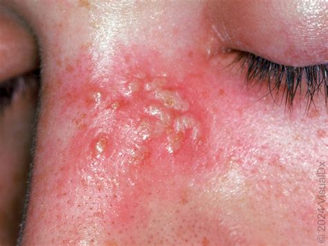 Herpes Simplex Virus (HSV) (Includes Erythema Multiforme) – DermAlive