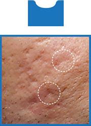top acne scars treatment  boston lasercoring subcision