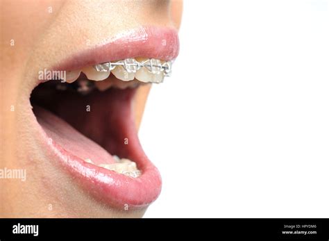 ceramic braces teeth  res stock photography  images alamy