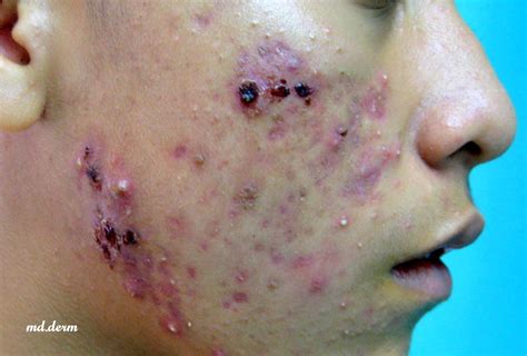 Propionibacterium acnes - لامل
