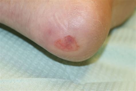 Diabetic Foot Ulcer Wagner Classification