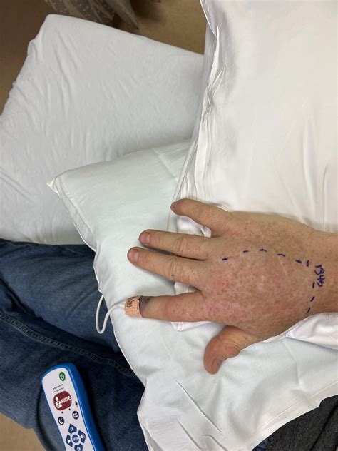 Bite from copperhead : r/snakes