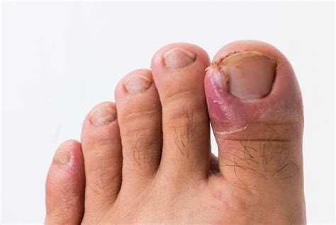 Podiatry Ingrown Toenail | Round House Podiatry