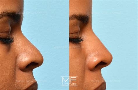 4 Ways To Make Your Nose Appear Smaller With Filler | Mabrie Facial
