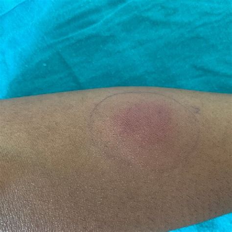 how to know if tuberculin skin test is positive